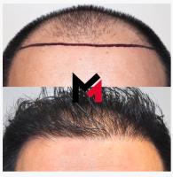 MAXIM Hair Restoration image 2